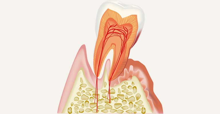 歯周病 イメージ