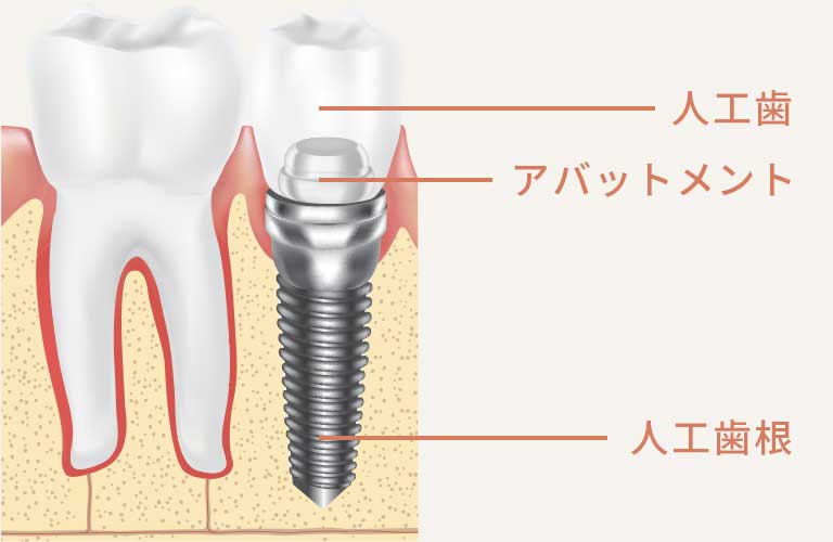 インプラントの構造