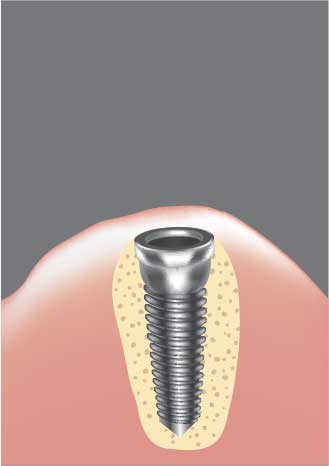 インプラント埋入