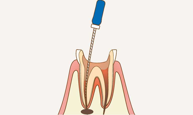 根管治療のイラスト