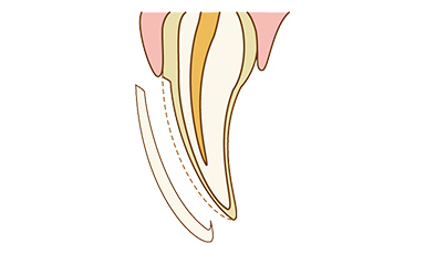 テトラサイクリン歯 イメージ