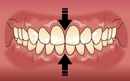 クレンチング（かみしめ） イメージ