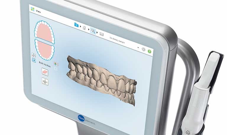 iTero®エレメント　スキャンしたイメージ