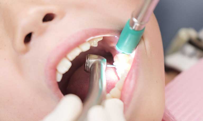 幼児の虫歯治療の様子