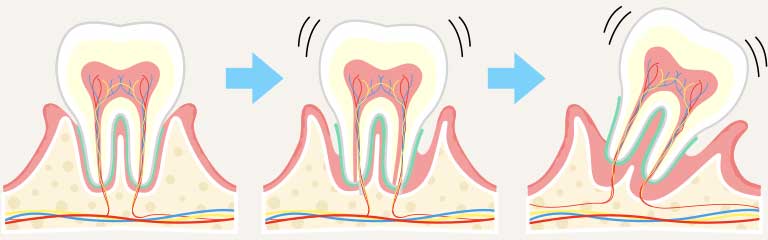 歯肉炎から歯周炎へ進行する様子