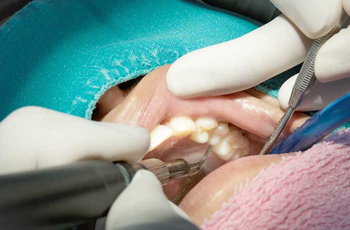 歯周外科治療の様子