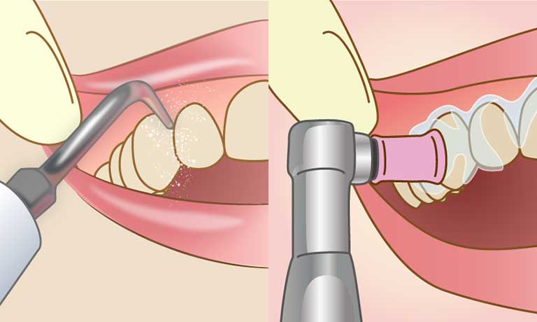 歯石取りとPMTCの違い イメージ