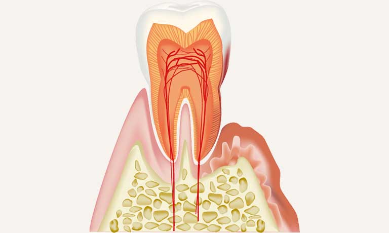 歯槽膿漏イメージ